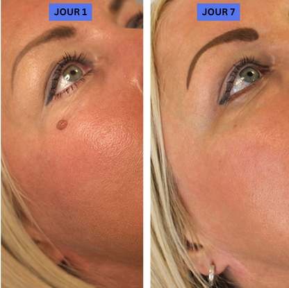 TagBuddy™ – Kit d’Élimination des Acrochordons