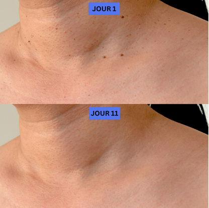 TagBuddy™ – Kit d’Élimination des Acrochordons