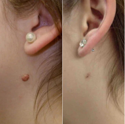 TagBuddy™ – Kit d’Élimination des Acrochordons