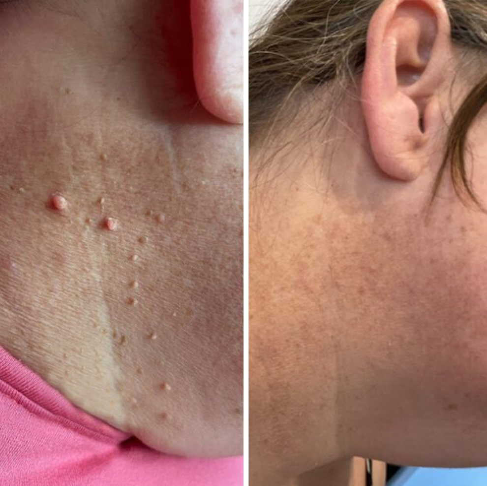 TagBuddy™ – Kit d’Élimination des Acrochordons