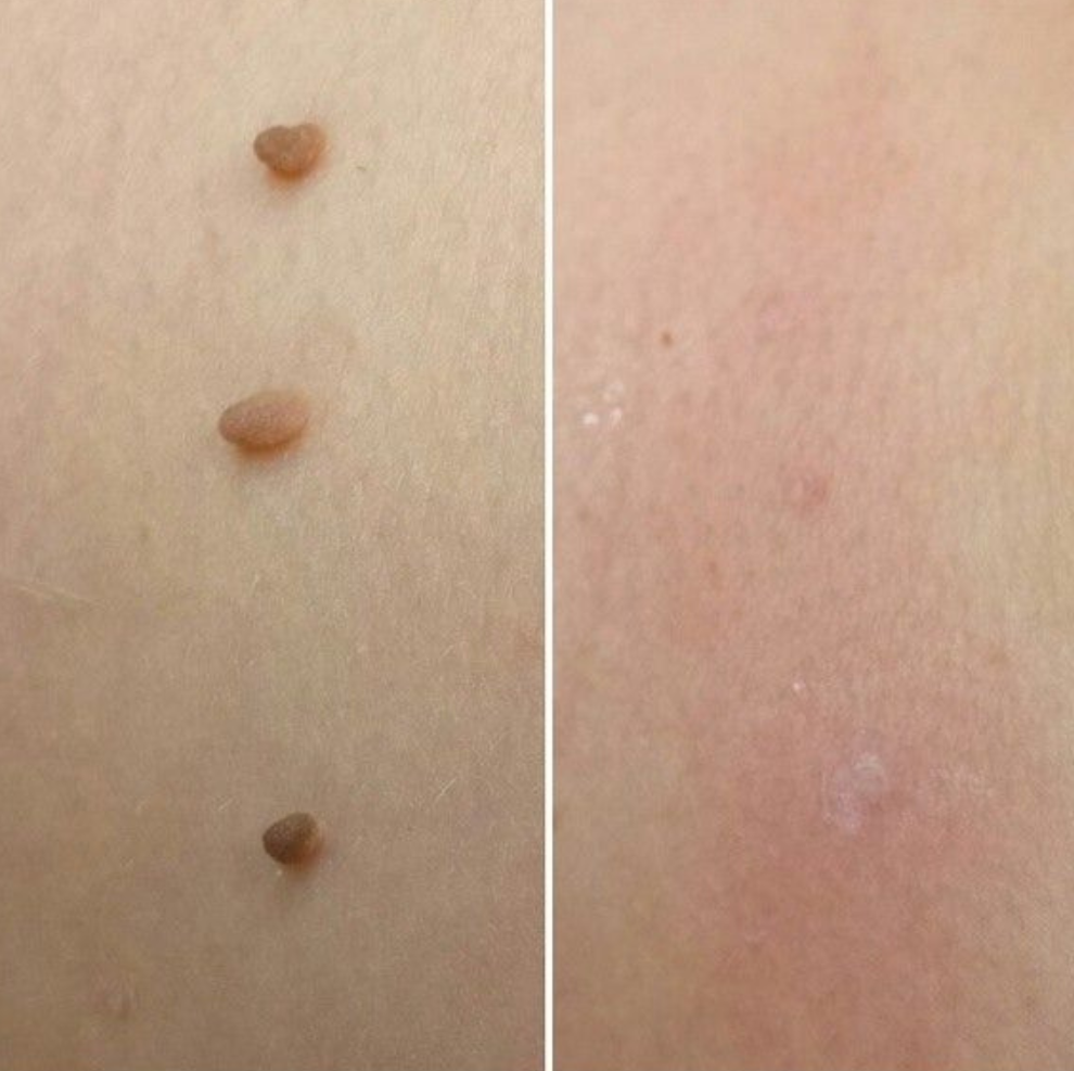 TagBuddy™ – Kit d’Élimination des Acrochordons