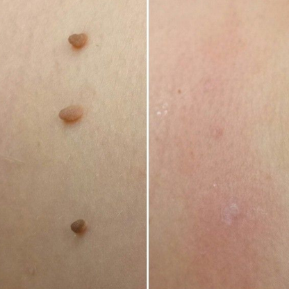 TagBuddy™ – Kit d’Élimination des Acrochordons